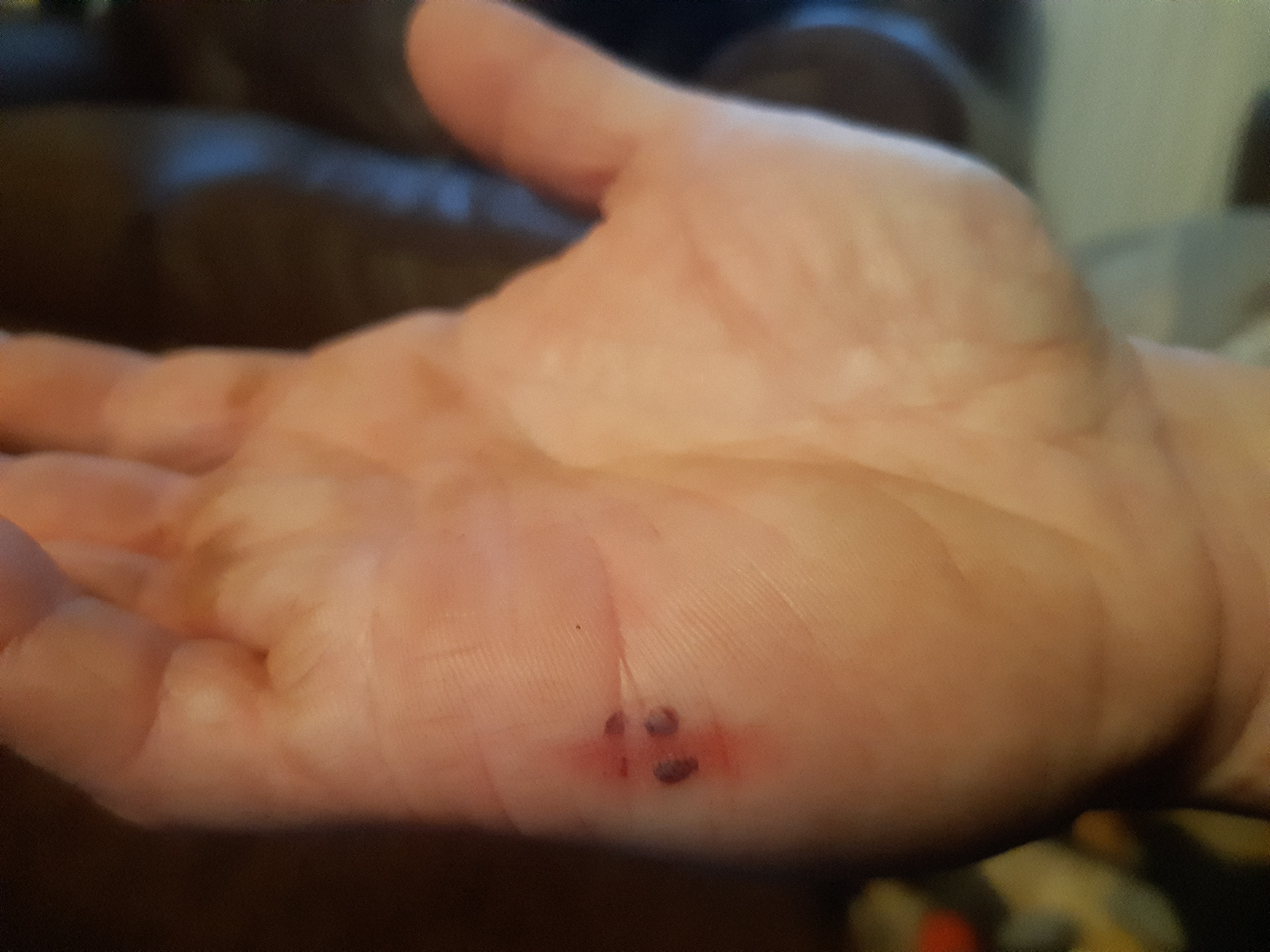 Bruised Hand